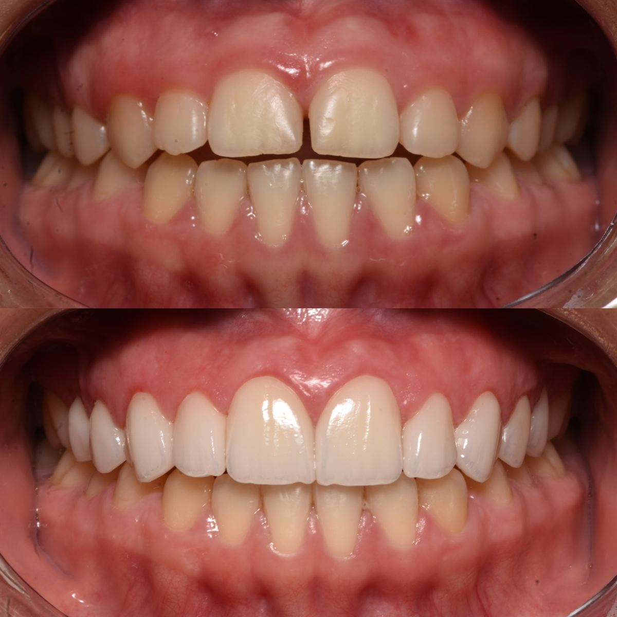 Antes e depois: fechamento de diastema com lentes de contato