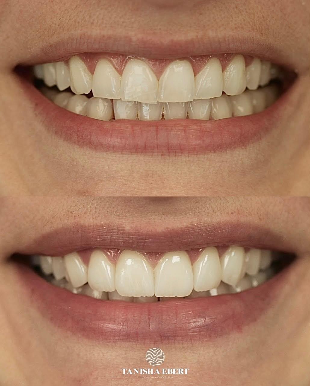 Antes e depois de lentes de contato dental em tom natural
