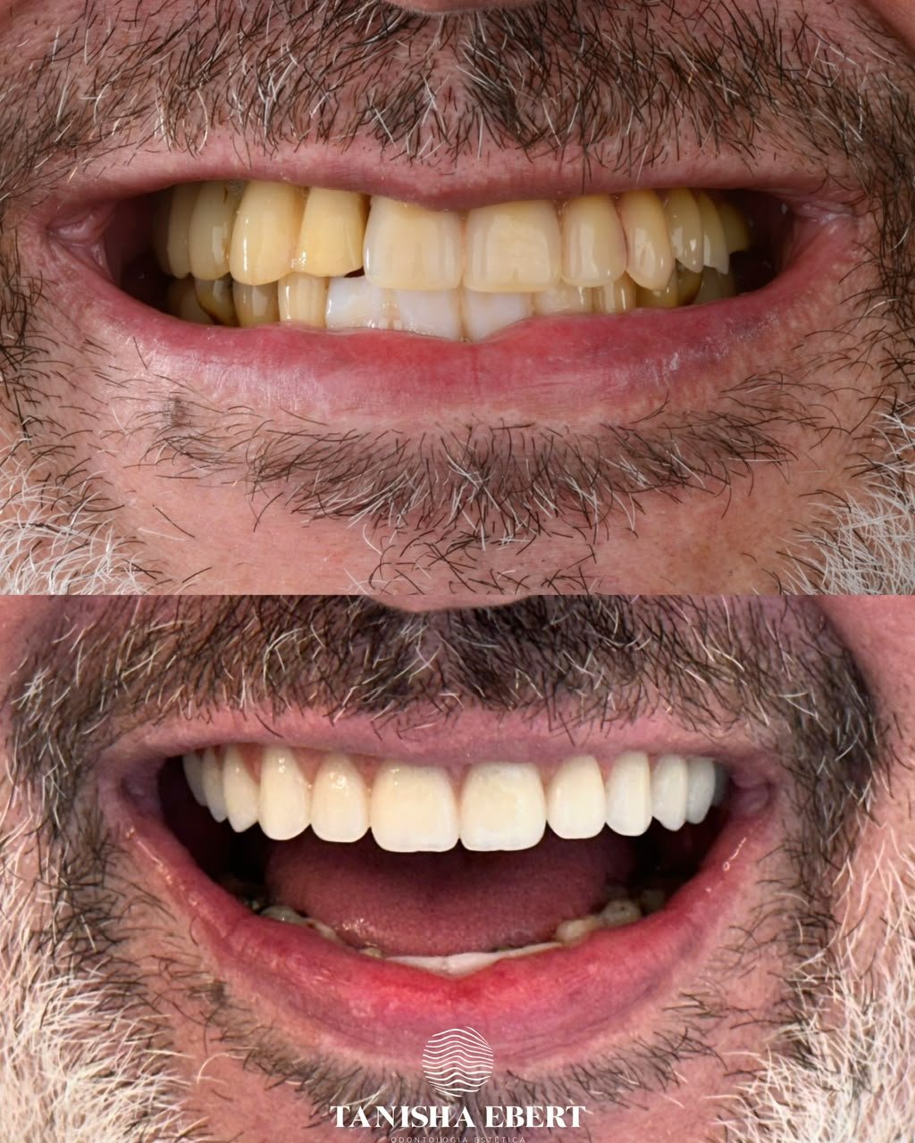 Antes e depois de uma reabilitação oral, vista de frente