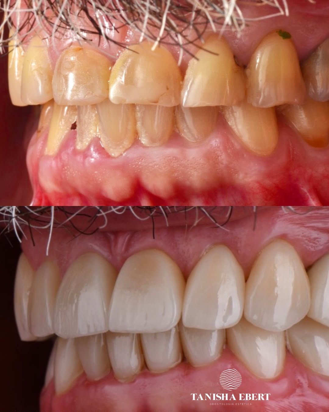 Antes e depois de uma reabilitação oral, vista lateral aproximada